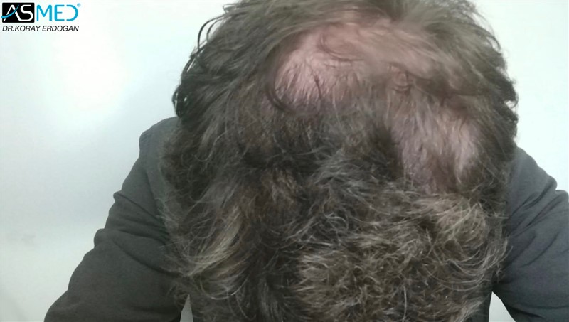 Norwood5 4214-grafts-FUE 6months AFT5