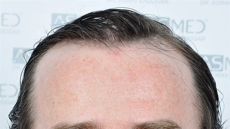 Norwood5 4214-grafts-FUE before BEFORE1