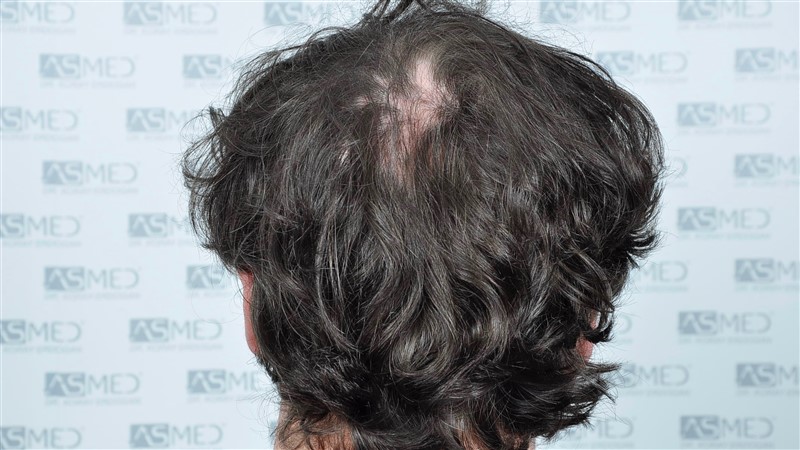 Norwood5 4214-grafts-FUE before BEFORE2