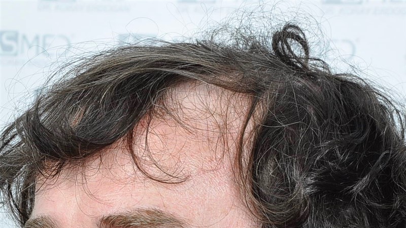 Norwood5 4214-grafts-FUE before BEFORE4