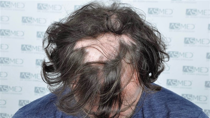 Norwood5 4214-grafts-FUE before BEFORE5