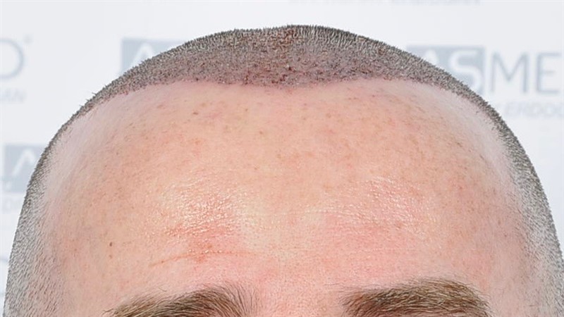 Norwood5 4214-grafts-FUE operation OP1