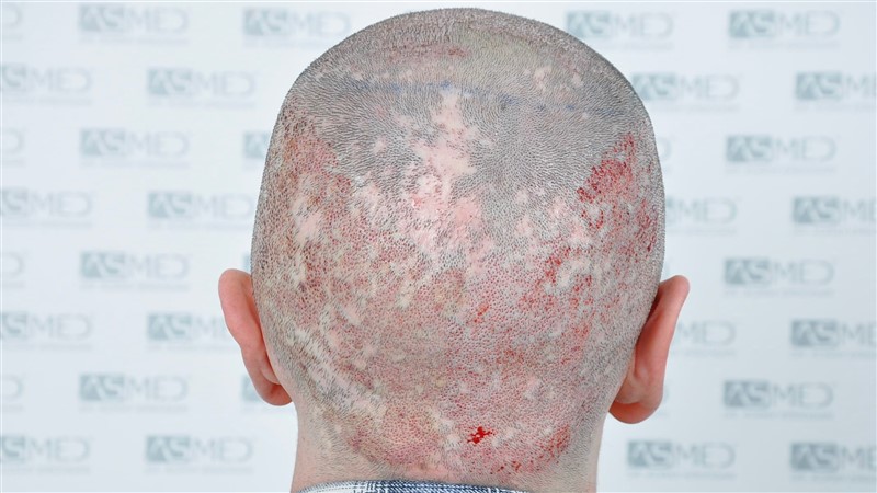 Norwood5 4214-grafts-FUE operation OP2