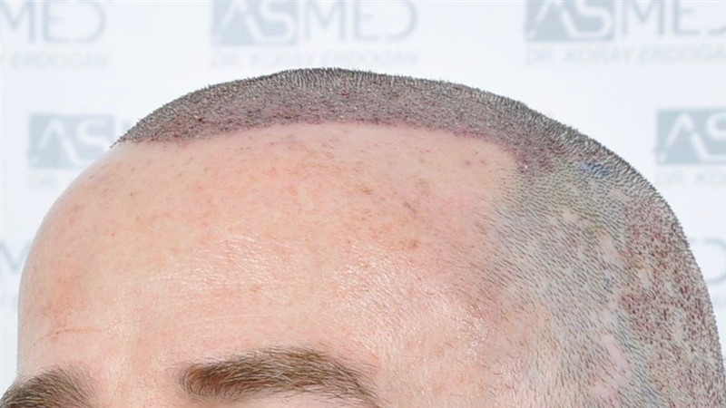 Norwood5 4214-grafts-FUE operation OP4