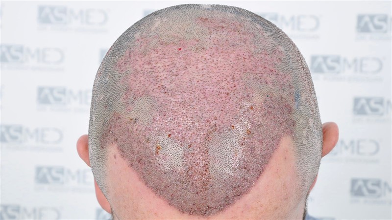 Norwood5 4214-grafts-FUE operation OP5