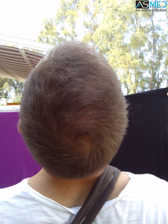 Norwood5 4400-grafts-FUE file_zps0e829071