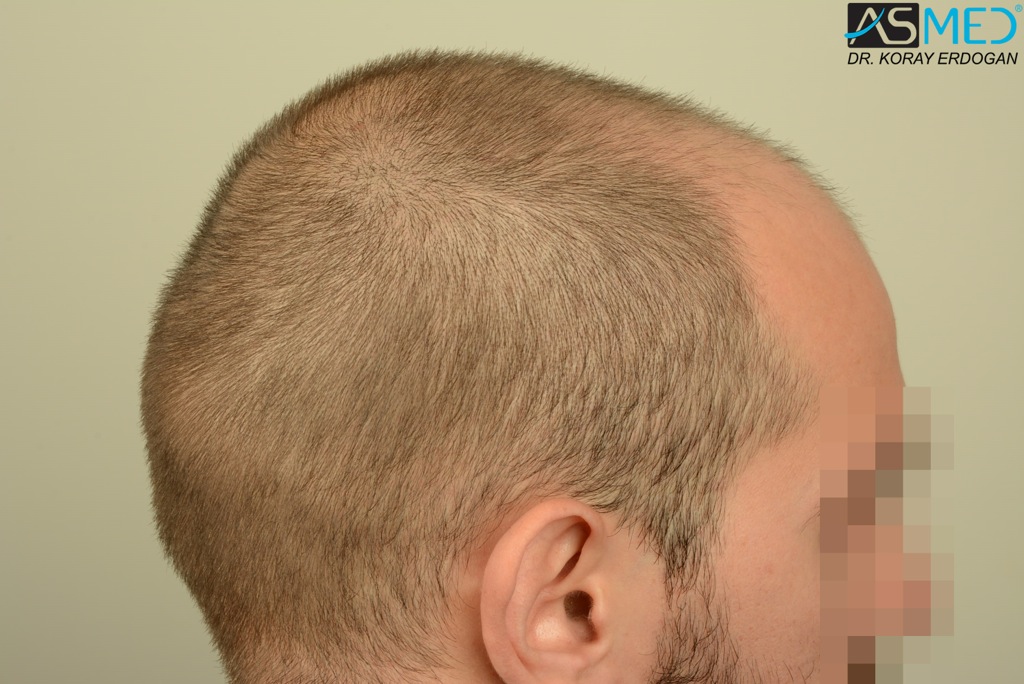 Norwood5 4400-grafts-FUE file_zps2ed6f66b
