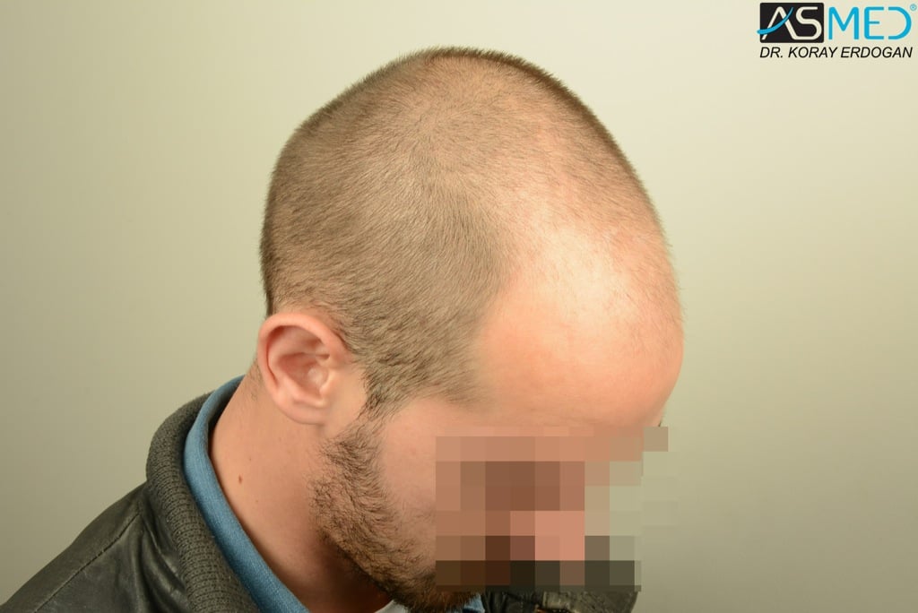 Norwood5 4400-grafts-FUE file_zps319a0317