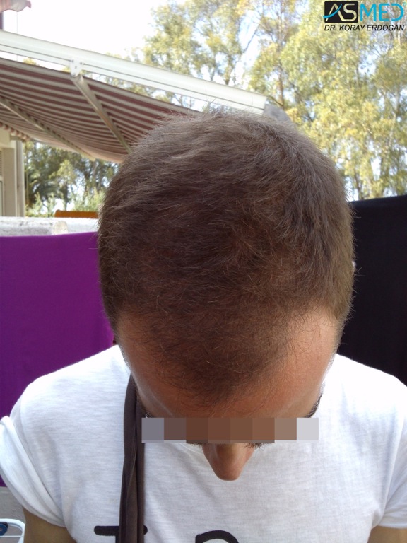 Norwood5 4400-grafts-FUE file_zps56e0573b