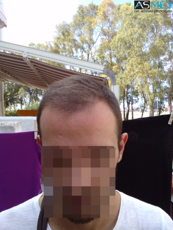 Norwood5 4400-grafts-FUE file_zps5cf9b3d0