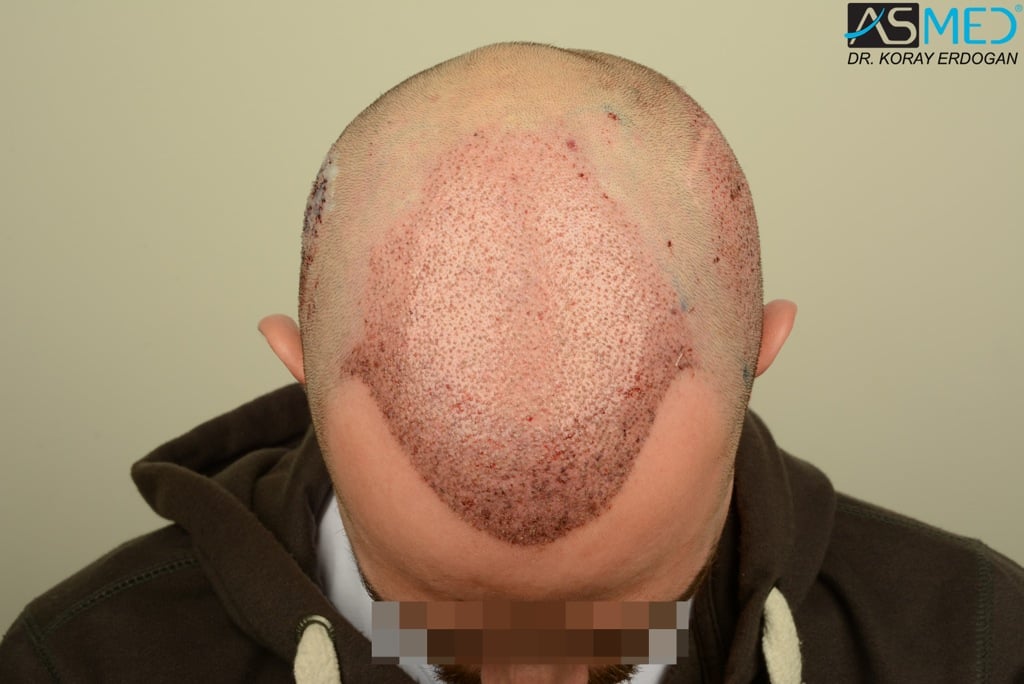 Norwood5 4400-grafts-FUE file_zps6089b461