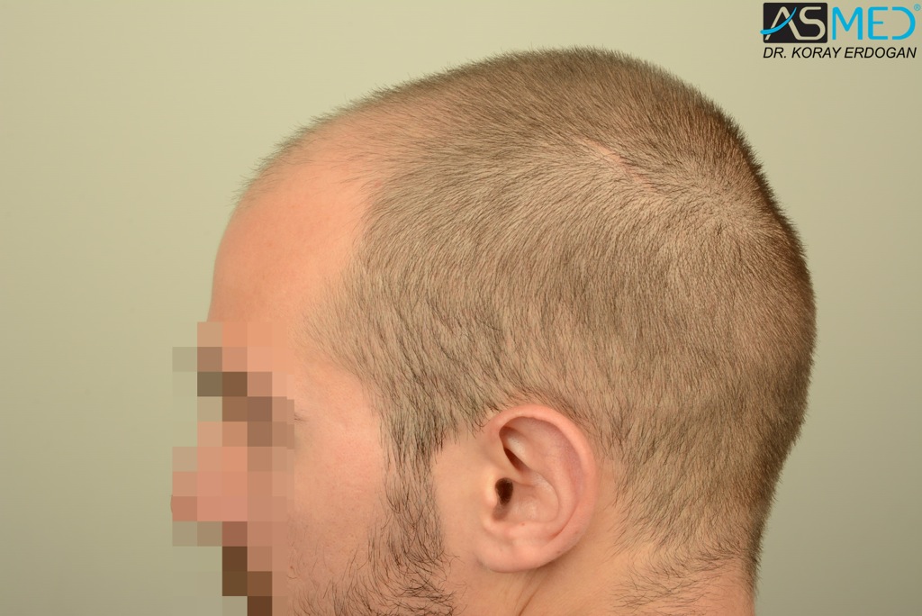 Norwood5 4400-grafts-FUE file_zps7286e01e