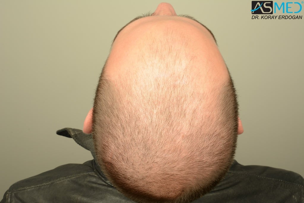 Norwood5 4400-grafts-FUE file_zps81e32657