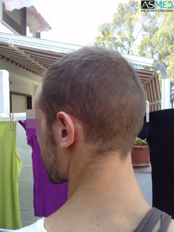 Norwood5 4400-grafts-FUE file_zps93b54b01