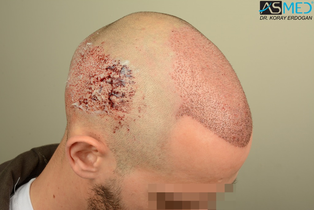Norwood5 4400-grafts-FUE file_zps9a090cfe