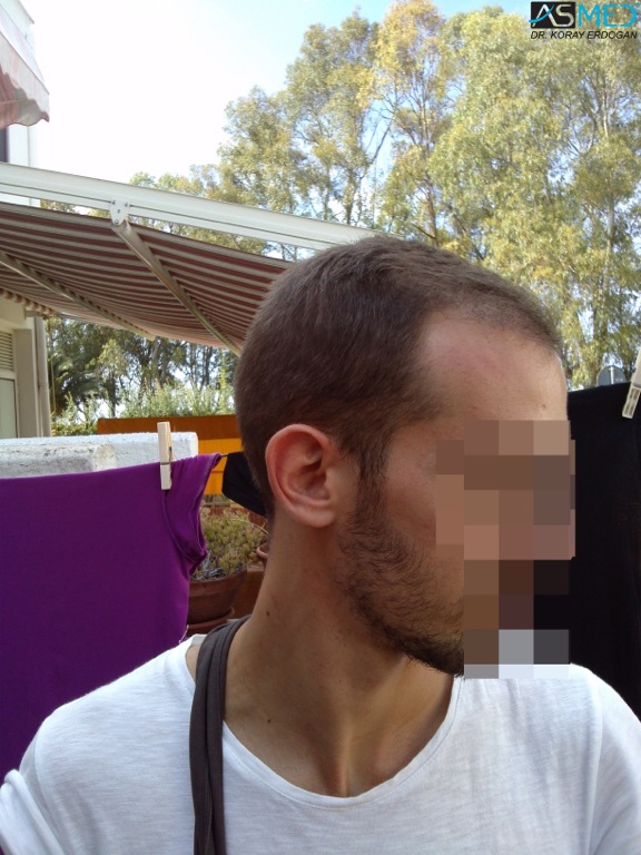 Norwood5 4400-grafts-FUE file_zpsa1cc04ca