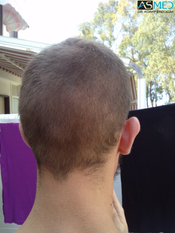 Norwood5 4400-grafts-FUE file_zpsa2c88d6b