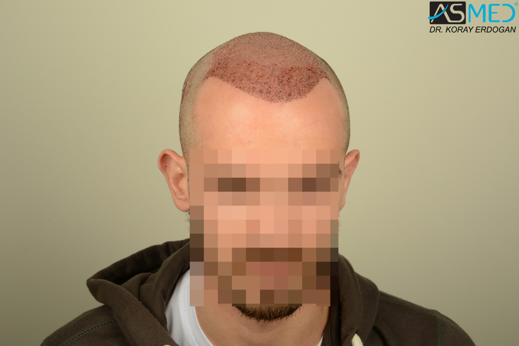 Norwood5 4400-grafts-FUE file_zpsba0c7991