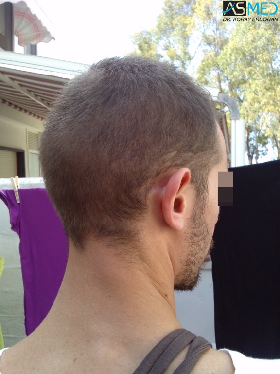 Norwood5 4400-grafts-FUE file_zpsca77a8fa