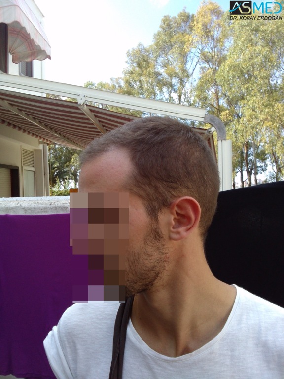 Norwood5 4400-grafts-FUE file_zpsd0487e65