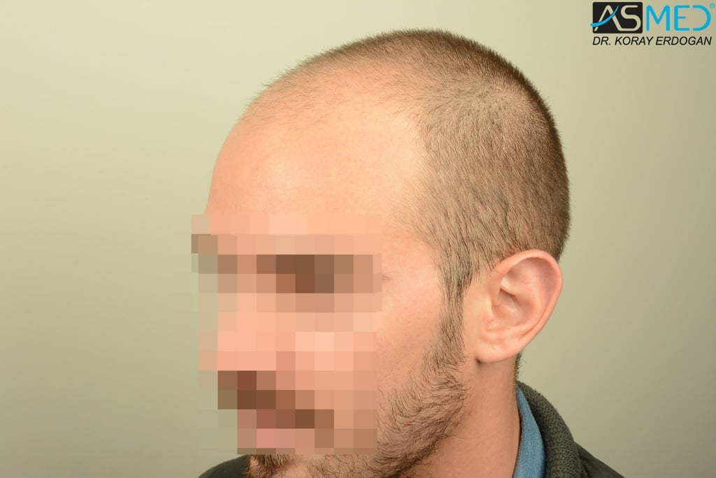 Norwood5 4400-grafts-FUE file_zpsee78d030