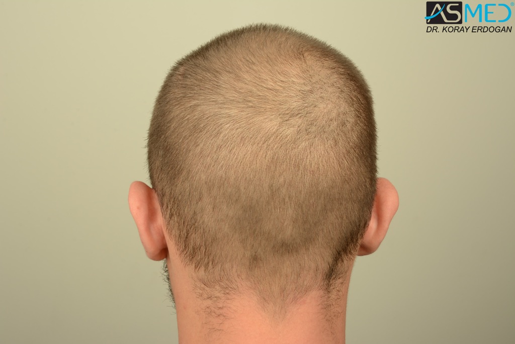 Norwood5 4400-grafts-FUE file_zpsefee8c6a
