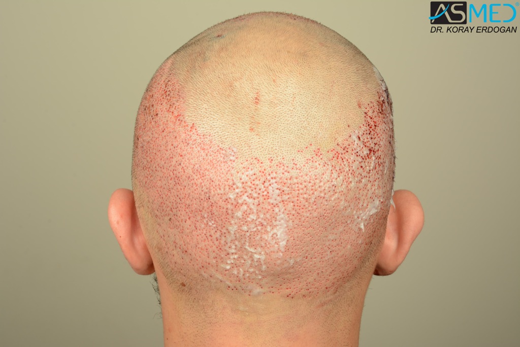 Norwood5 4400-grafts-FUE file_zpsfb45d8f4