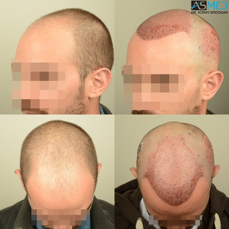 Norwood5 4400-grafts-FUE file_zpsff2106b0