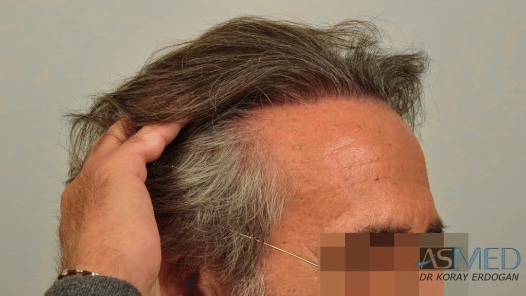 Norwood5 4818-grafts-FUE-2400-FUE-2418-FUE file_zps6281336d