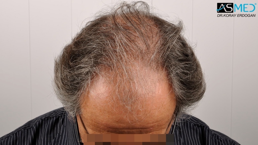 Norwood5 4818-grafts-FUE-2400-FUE-2418-FUE file_zps69f68f3a