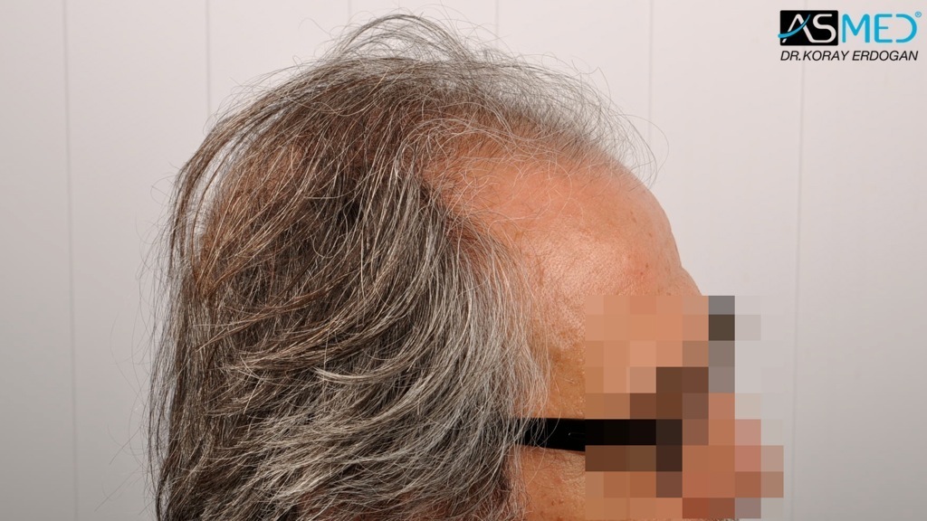 Norwood5 4818-grafts-FUE-2400-FUE-2418-FUE file_zps9c0ad808