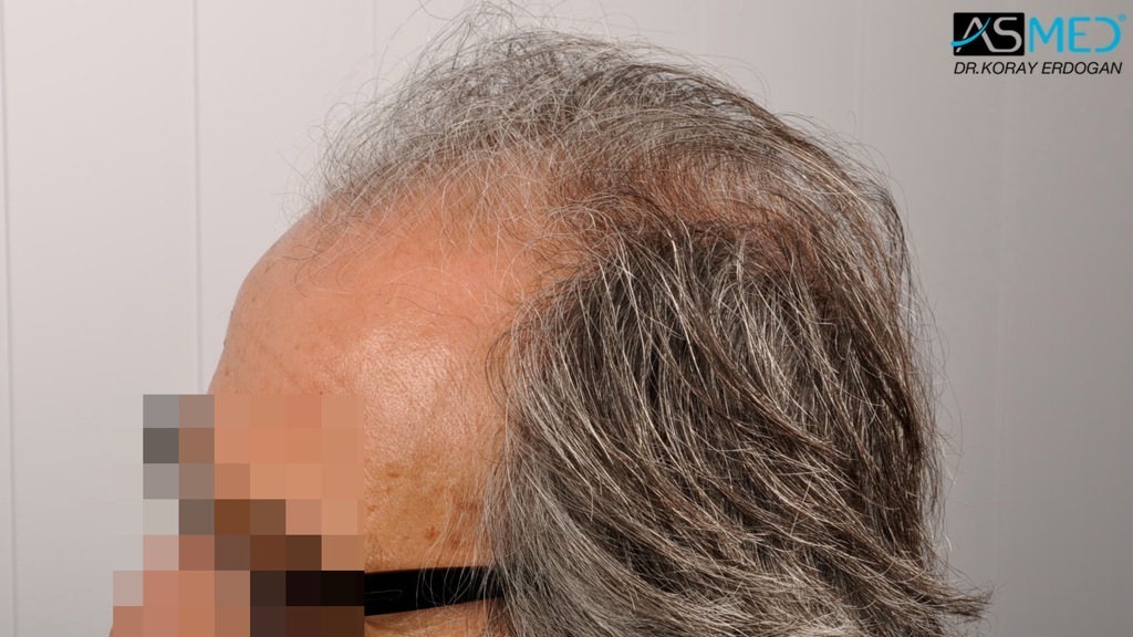 Norwood5 4818-grafts-FUE-2400-FUE-2418-FUE file_zpsa2027341