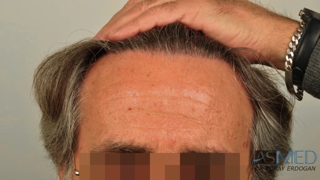 Norwood5 4818-grafts-FUE-2400-FUE-2418-FUE file_zpsabe2201a