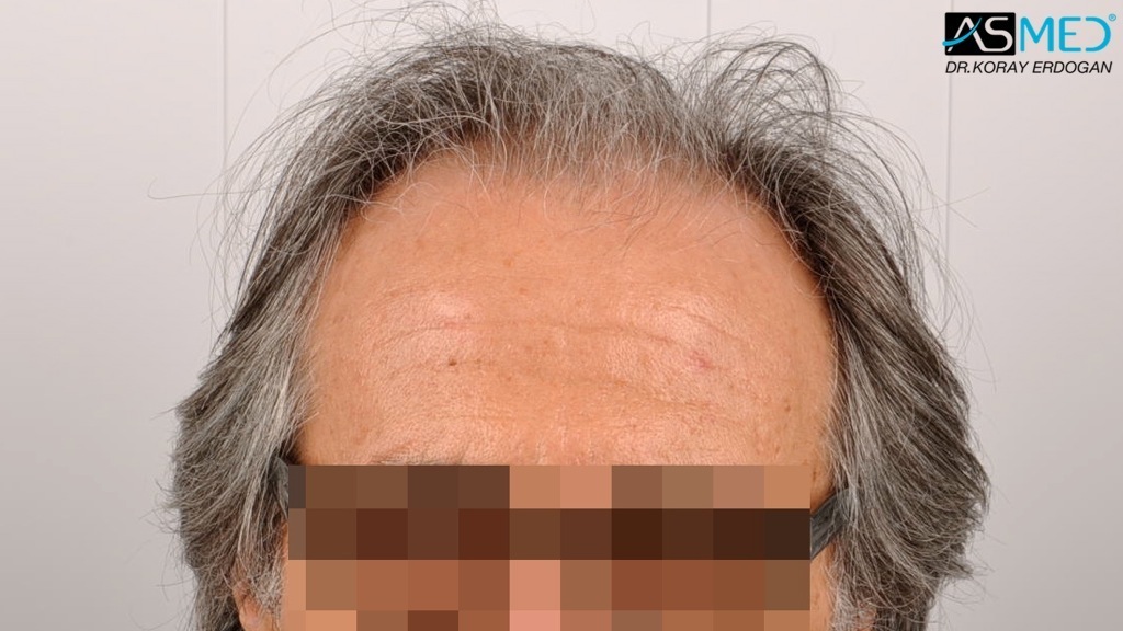 Norwood5 4818-grafts-FUE-2400-FUE-2418-FUE file_zpse17f4445