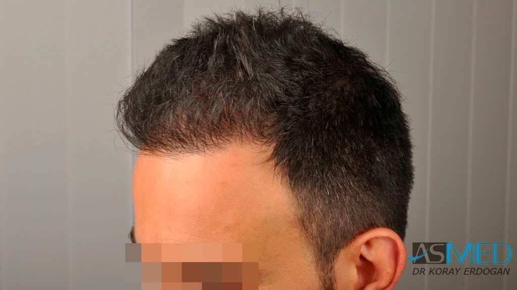 Norwood5 4876-grafts-FUE-2811-FUE-2065-FUE 0269513f