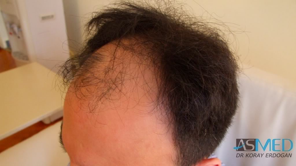 Norwood5 4876-grafts-FUE-2811-FUE-2065-FUE 045a2655