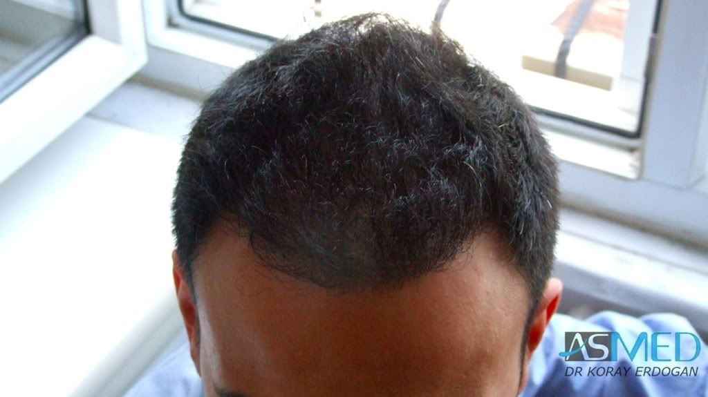 Norwood5 4876-grafts-FUE-2811-FUE-2065-FUE 0746bde4