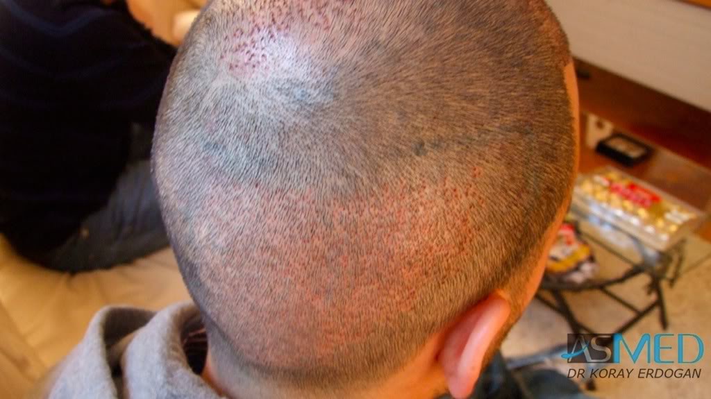 Norwood5 4876-grafts-FUE-2811-FUE-2065-FUE 222c85da