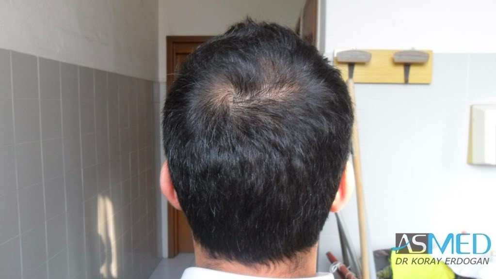 Norwood5 4876-grafts-FUE-2811-FUE-2065-FUE 2a221a8a