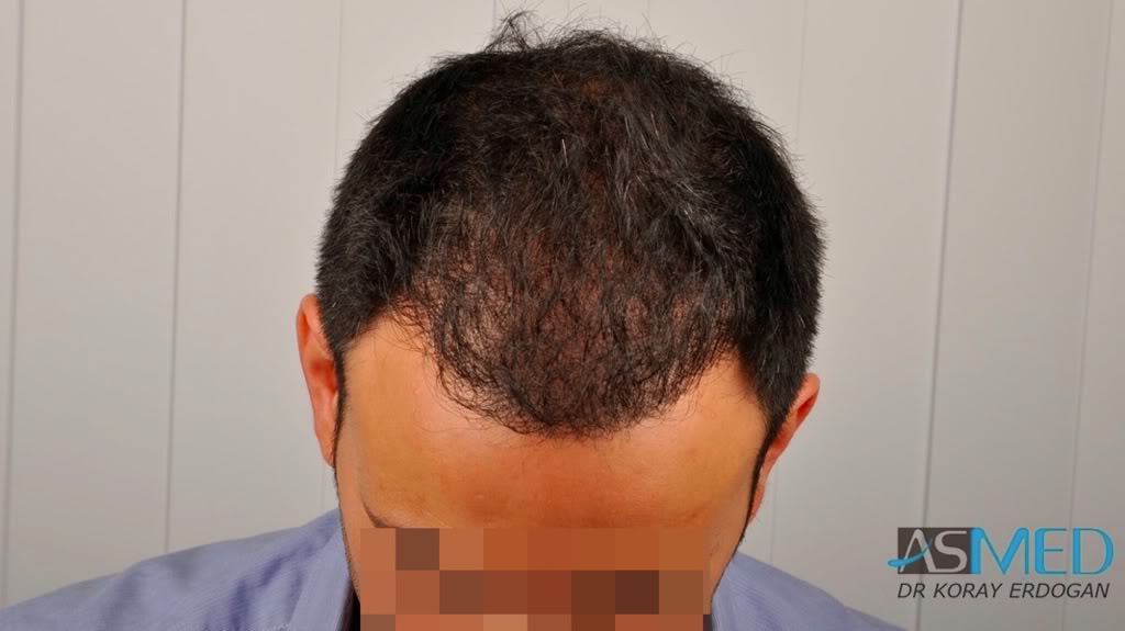 Norwood5 4876-grafts-FUE-2811-FUE-2065-FUE 38d32b93