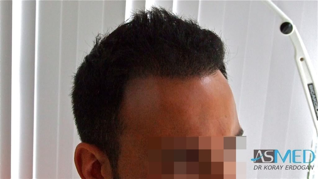 Norwood5 4876-grafts-FUE-2811-FUE-2065-FUE 5a5cd615