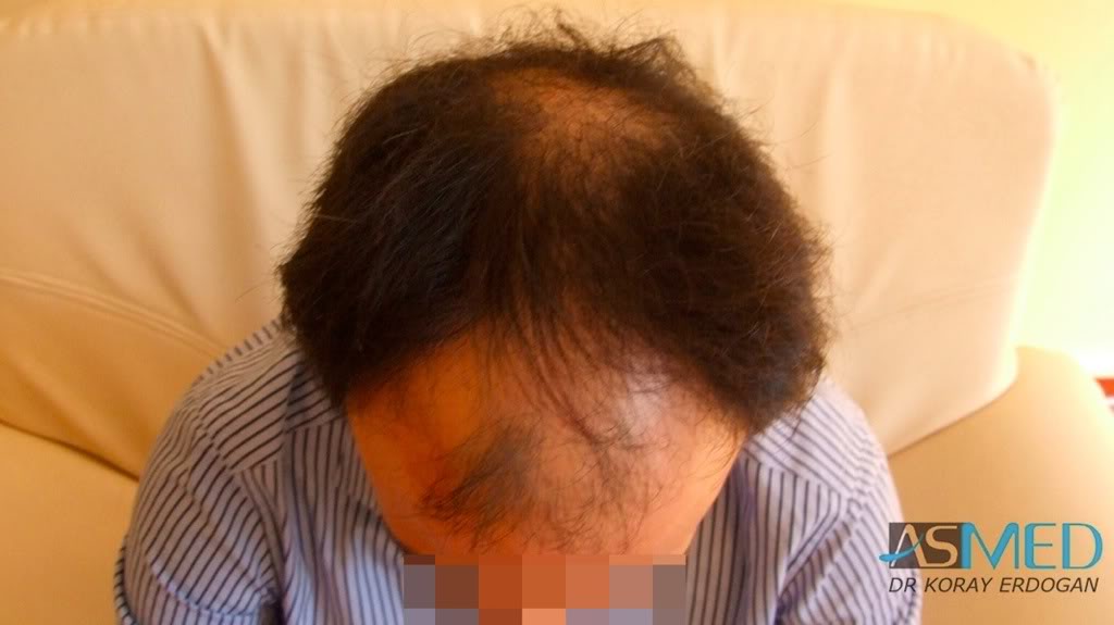 Norwood5 4876-grafts-FUE-2811-FUE-2065-FUE 63b5bd70