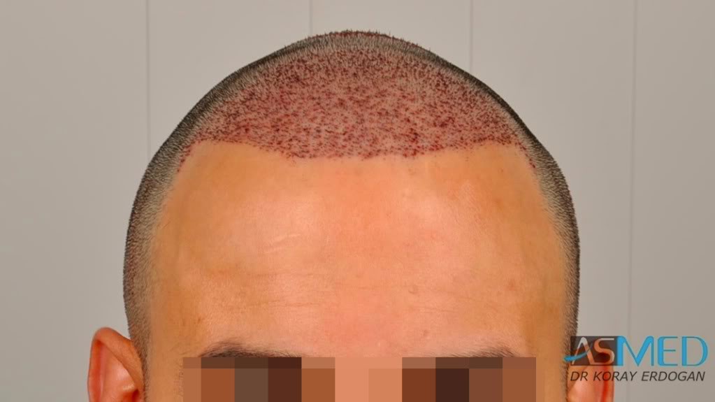Norwood5 4876-grafts-FUE-2811-FUE-2065-FUE 8df6c3b9