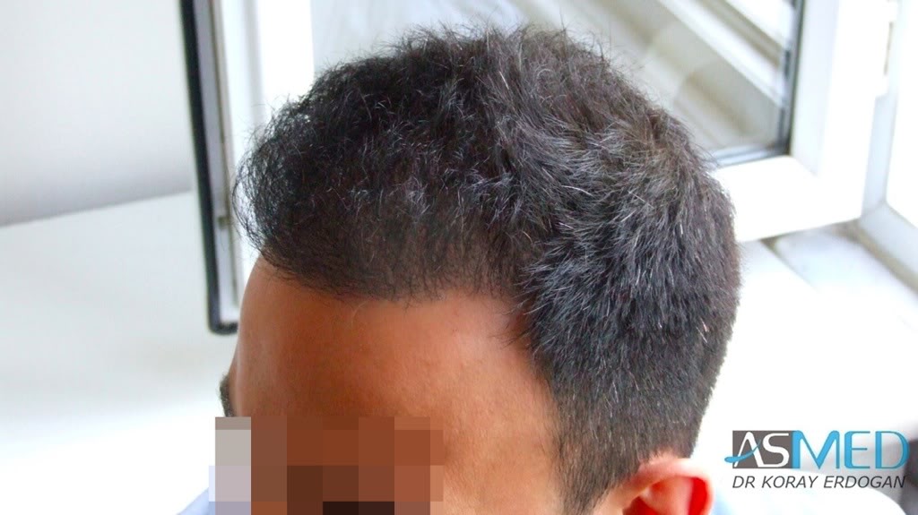 Norwood5 4876-grafts-FUE-2811-FUE-2065-FUE a2007204