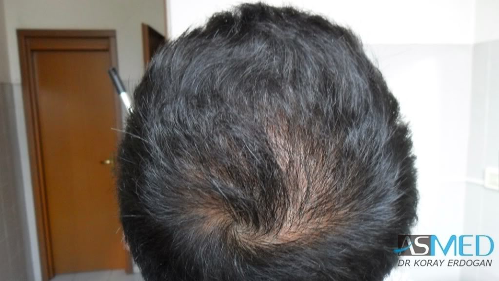 Norwood5 4876-grafts-FUE-2811-FUE-2065-FUE bece9997
