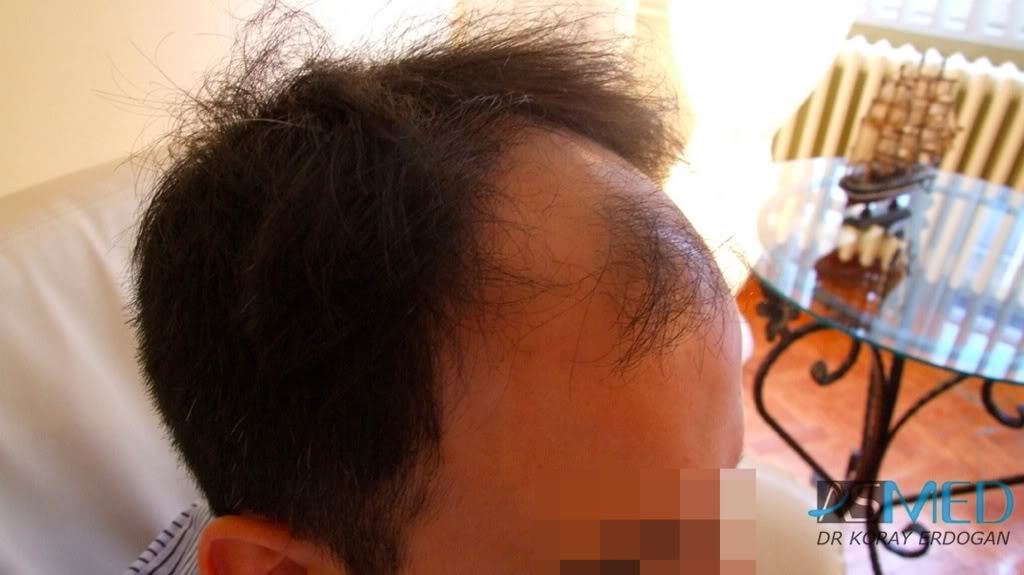 Norwood5 4876-grafts-FUE-2811-FUE-2065-FUE c9a023c5