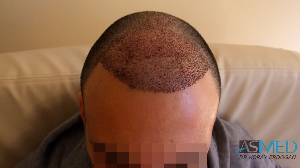 Norwood5 4876-grafts-FUE-2811-FUE-2065-FUE d58b013c