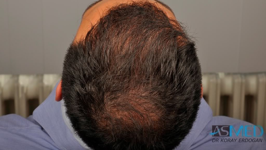 Norwood5 4876-grafts-FUE-2811-FUE-2065-FUE df23eb3e