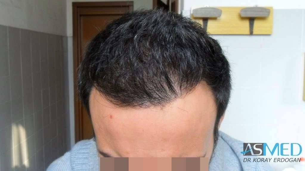 Norwood5 4876-grafts-FUE-2811-FUE-2065-FUE f6ba6e61