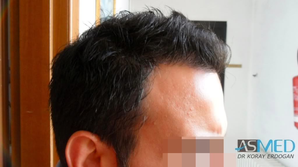 Norwood5 4876-grafts-FUE-2811-FUE-2065-FUE f8c714ce